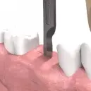 Установка имплатнов